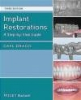 Implant Restorations Carl Drago