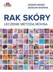 Rak skóry Leczenie metodą Mohsa - Woźniak Zdzisław, Bieniek Andrzej