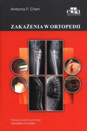 Zakażenia w ortopedii - Antonia F. Chen