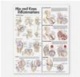 Hip and Knee Inflammations Anatomical Chart Anatomical Chart Company