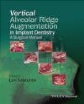 Vertical Augmentation of the Alveolar Ridge in Implant Dentistry Len Tolstunov