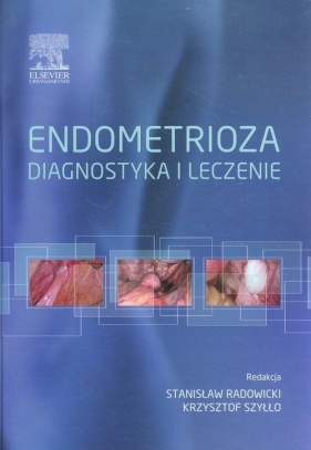 Endometrioza diagnostyka i leczenie - <br />