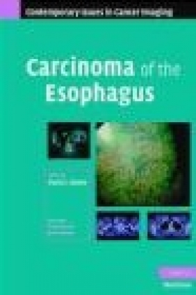Carcinoma of the Esophagus S Rankin