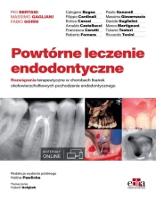Powtórne leczenie endodontyczne - Pio Bertani